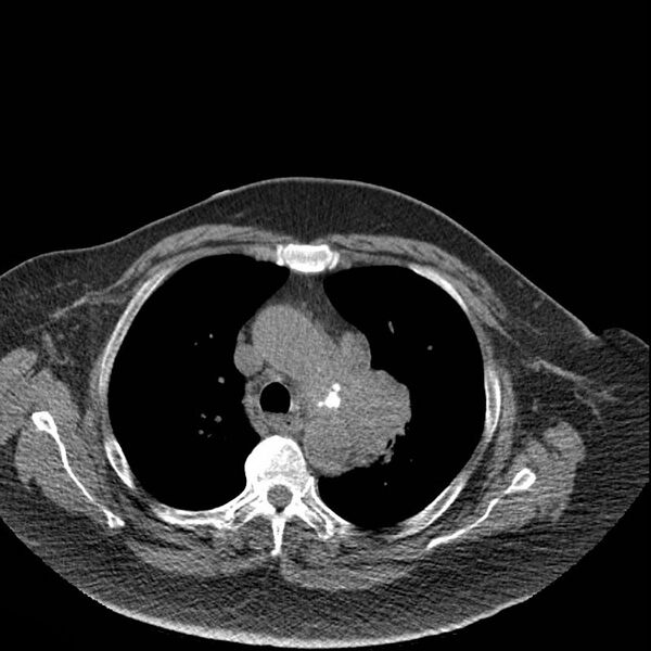 File:Aortic arch false aneurysm (Radiopaedia 14667-14587 Axial non-contrast 13).jpg