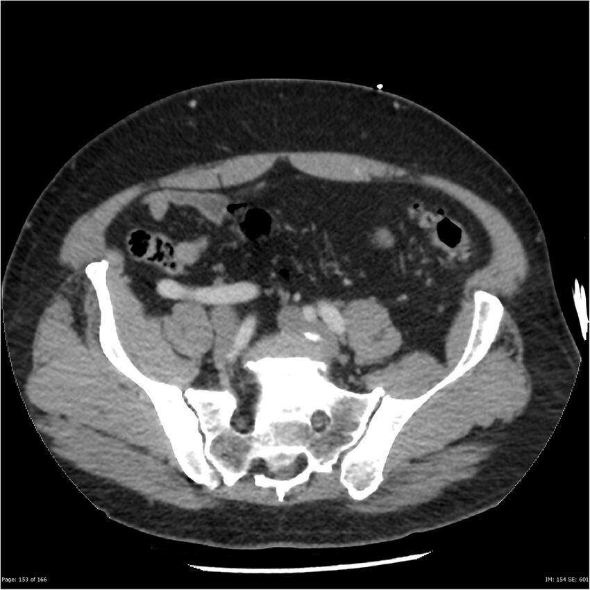 Aortic dissection- Stanford A (Radiopaedia 37759-39664 A 144).jpg