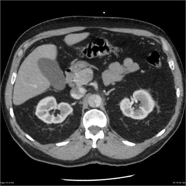File:Aortic dissection- Stanford A (Radiopaedia 37759-39664 A 84).jpg