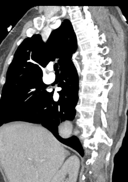 File:Aortic dissection - Stanford type B (Radiopaedia 50171-55512 C 41).png