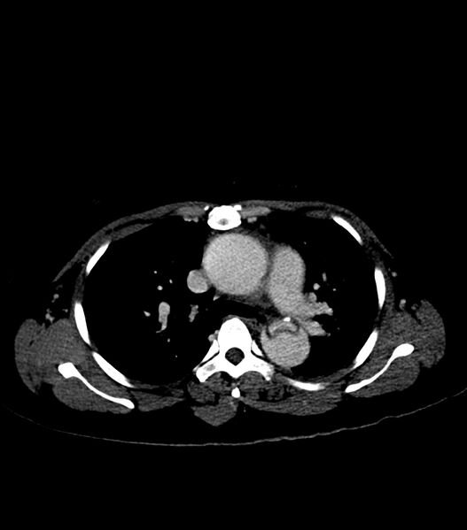 File:Aortic dissection with renal ischemia (Radiopaedia 76573-88338 B 11).jpg