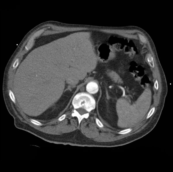 File:Aortic dissection with rupture into pericardium (Radiopaedia 12384-12647 A 52).jpg