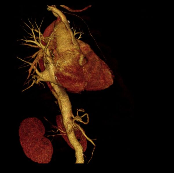 File:Aortic dissection with rupture into pericardium (Radiopaedia 12384-12647 D 7).jpg