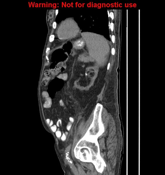 File:Aortic graft infection (Radiopaedia 44979-48907 C 19).jpg
