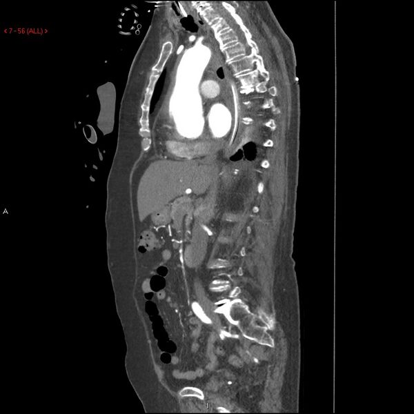 File:Aortic intramural hematoma (Radiopaedia 27746-28001 C 25).jpg