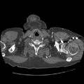 Aorto-coronary bypass graft aneurysms (Radiopaedia 40562-43157 A 7).png