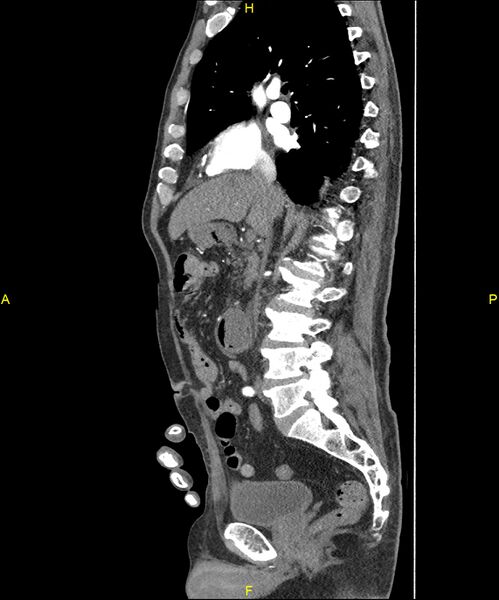 File:Aortoenteric fistula (Radiopaedia 84308-99603 C 151).jpg