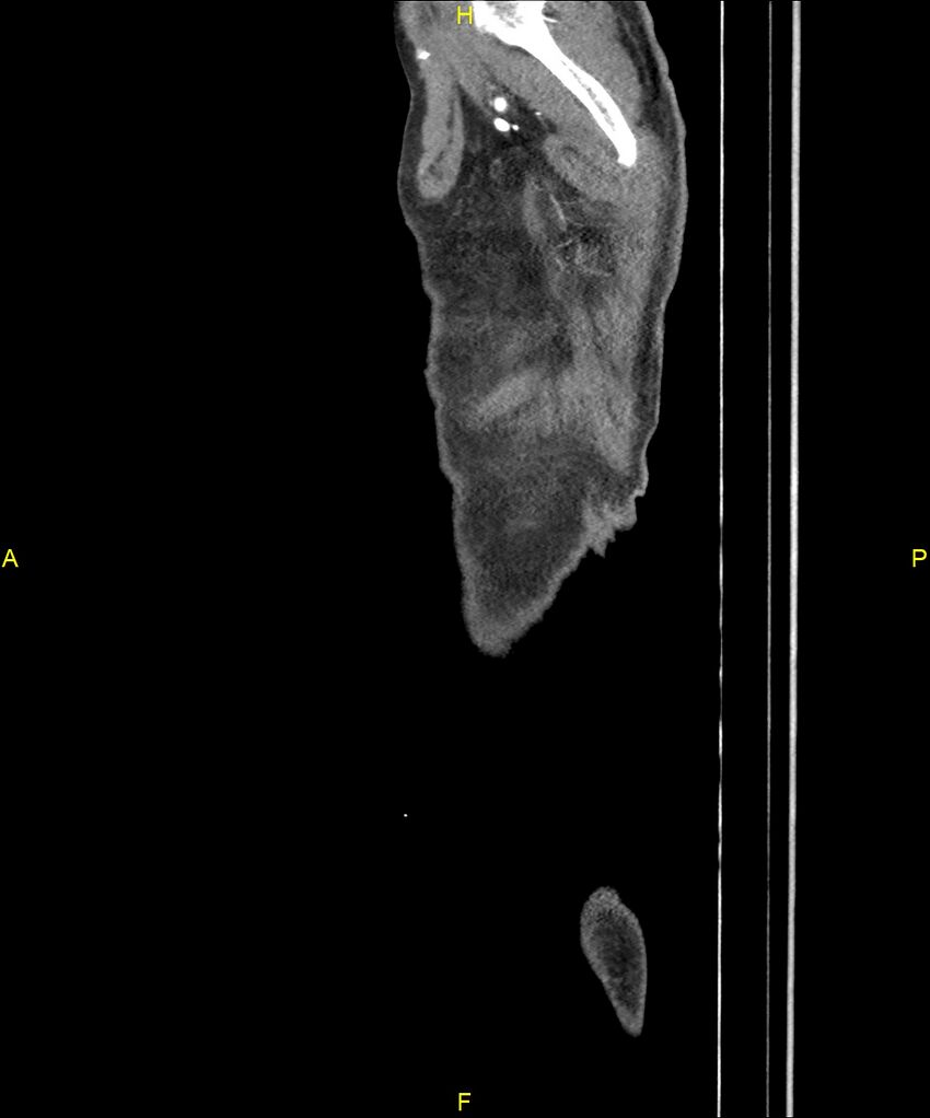 Aortoenteric fistula (Radiopaedia 84308-99603 C 338).jpg