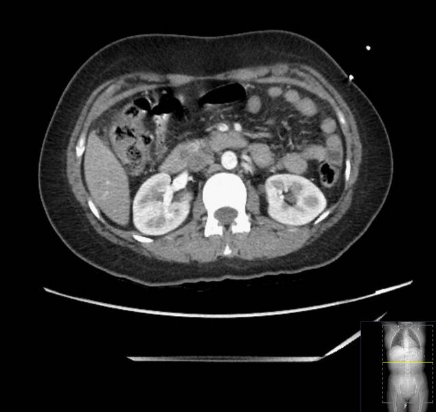 File:Appendicitis (CT angiogram) (Radiopaedia 154713-127660 Axial 115).jpg