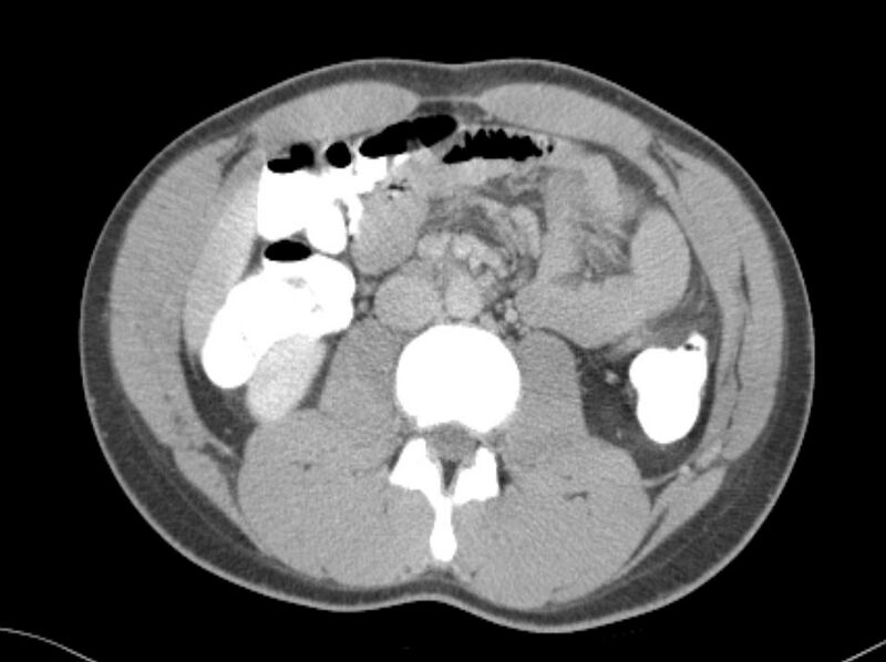 File:Appendicitis and incidental foregut duplication cyst (Radiopaedia 52962-58916 A 29).jpg