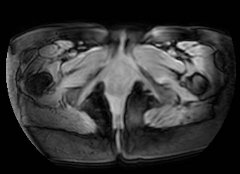 File:Appendicitis in gravida (MRI) (Radiopaedia 89433-106395 Axial DIXON 159).jpg