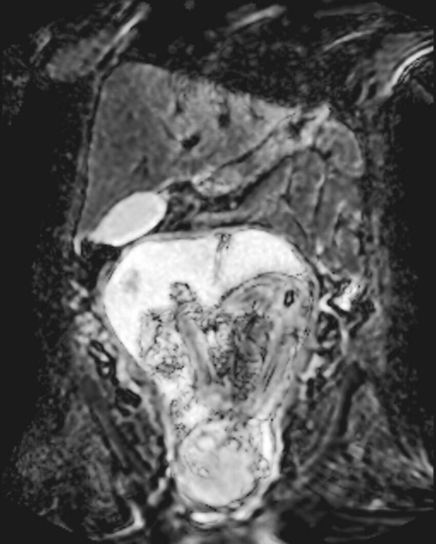 Appendicitis in gravida (MRI) (Radiopaedia 89433-106395 Coronal ADC 24).jpg