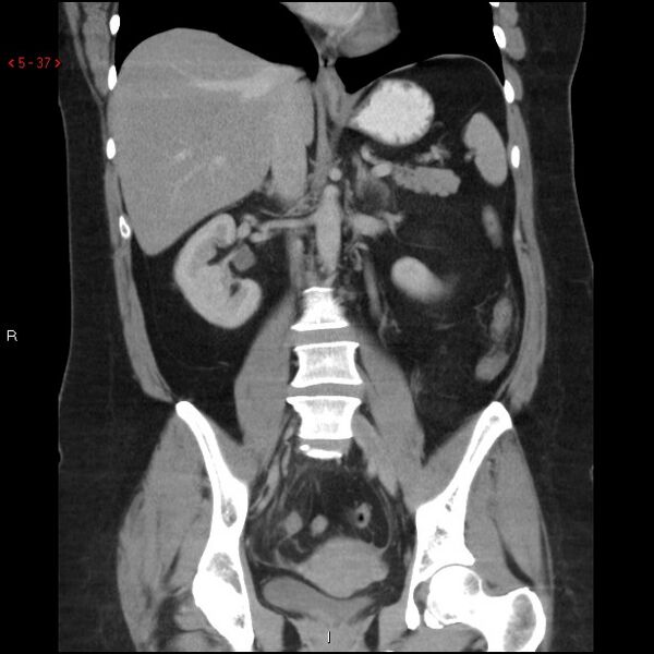 File:Appendicitis with microperforation- promontoric type (Radiopaedia 27268-27442 B 24).jpg