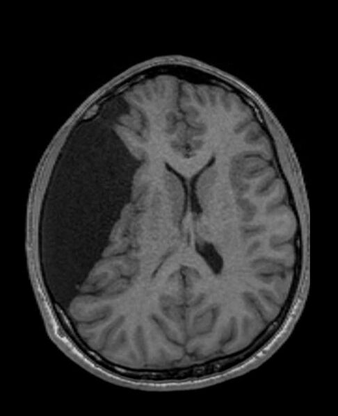 File:Arachnoid cyst- extremely large (Radiopaedia 68741-78451 Axial T1 46).jpg
