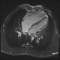 Arrhythmogenic right ventricular cardiomyopathy (Radiopaedia 57972-64966 A 22).jpg