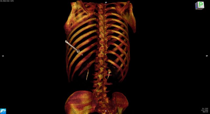 File:Arrow injury to the chest (Radiopaedia 75223-86321 3D bone 20).jpg