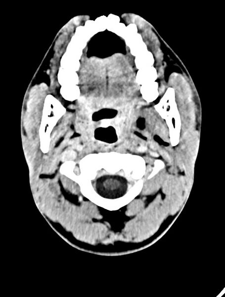 File:Arrow injury to the face (Radiopaedia 73267-84011 Axial C+ delayed 25).jpg