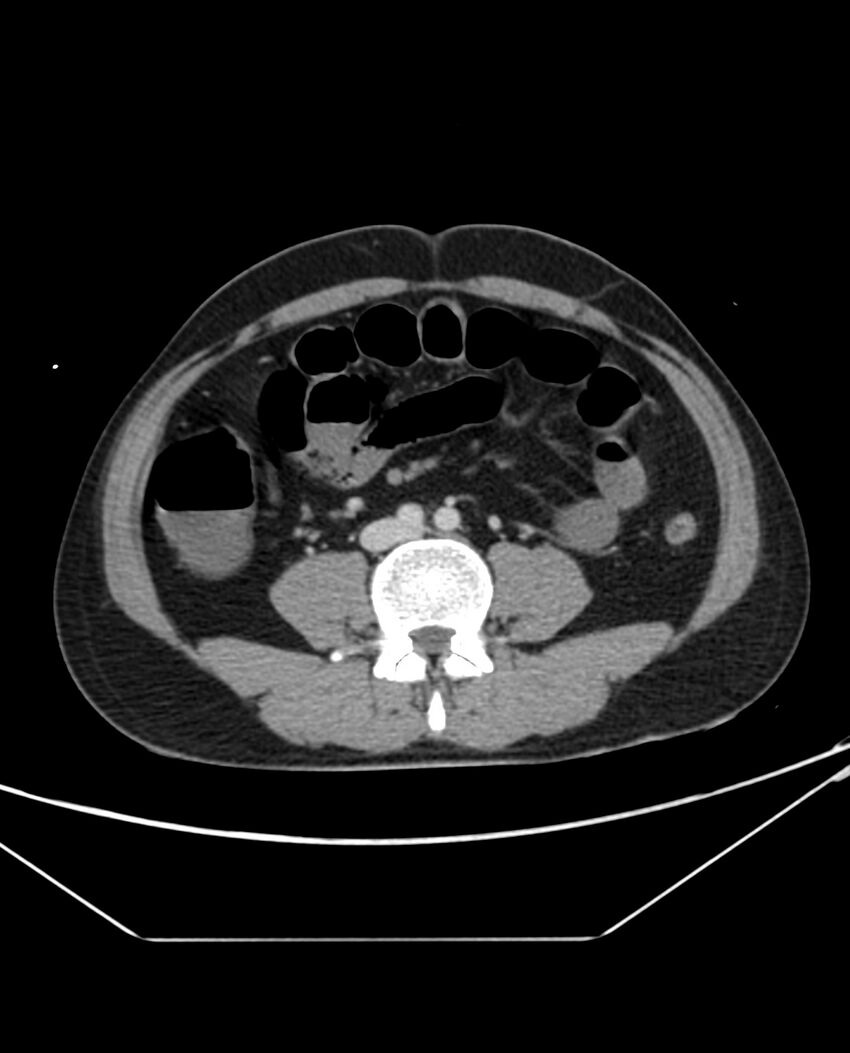 Arterial occlusive mesenteric ischemia (Radiopaedia 84641-100054 A 71).jpg