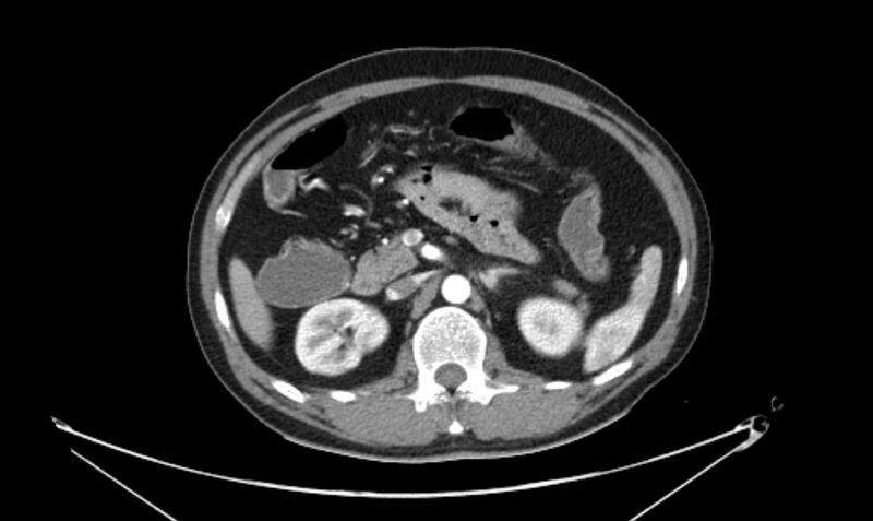 File:Arterial occlusive mesenteric ischemia (Radiopaedia 84641-100060 A 52).jpg