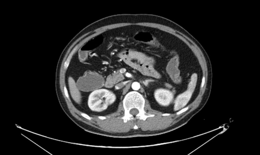 Arterial occlusive mesenteric ischemia (Radiopaedia 84641-100060 A 52).jpg