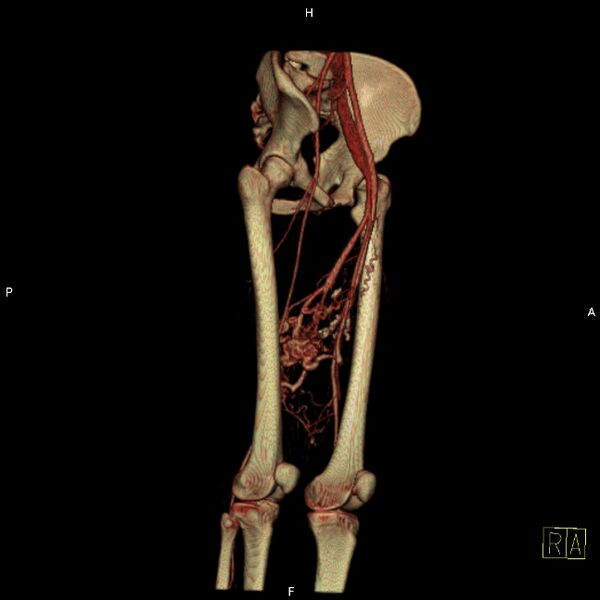 File:Arteriovenous malformation - thigh (Radiopaedia 14948-14883 3D reformat 9).jpg