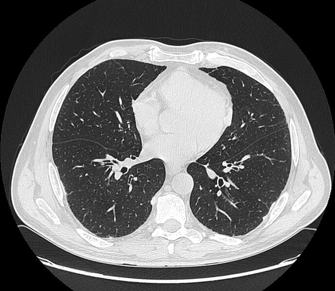 File:Asbestos pleural placques (Radiopaedia 57905-64872 Axial lung window 147).jpg