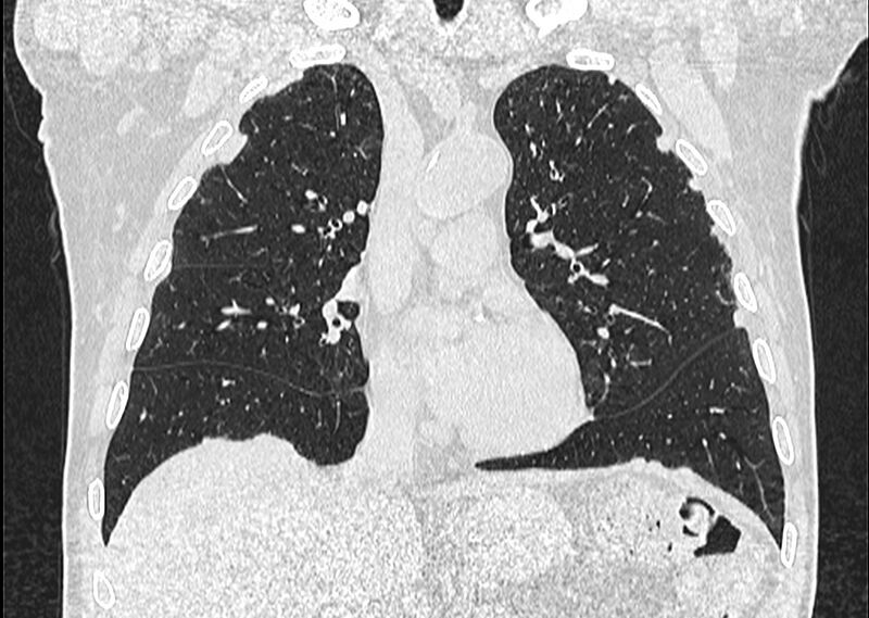 File:Asbestos pleural placques (Radiopaedia 57905-64872 Coronal lung window 121).jpg