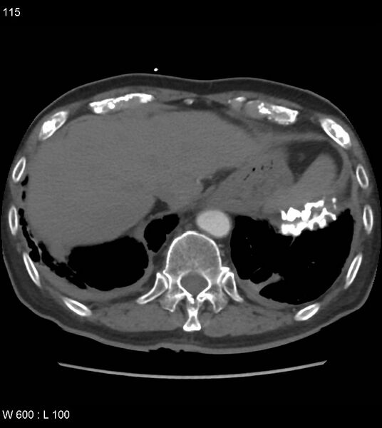 File:Asbestos related lung and pleural disease (Radiopaedia 14377-14301 D 51).jpg