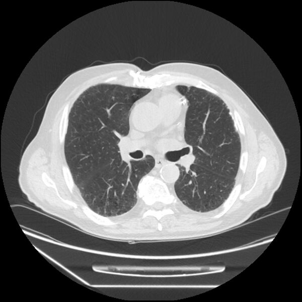 File:Asbestosis complicated by lung cancer (Radiopaedia 45834-50116 Axial lung window 33).jpg