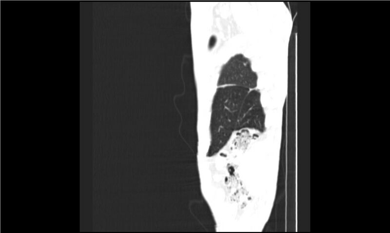 File:Aspergilloma (Radiopaedia 20788-20701 Sagittal lung window 20).jpg