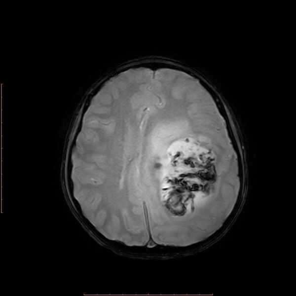 File:Astroblastoma (Radiopaedia 74287-85162 Axial SWI 14).jpg