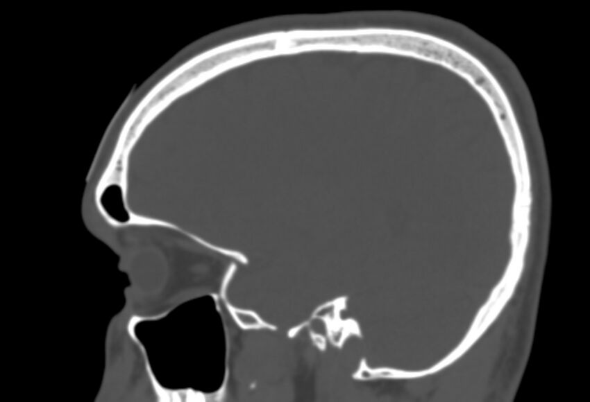 Asymptomatic occipital spur (Radiopaedia 87753-104201 Sagittal bone window 92).jpg