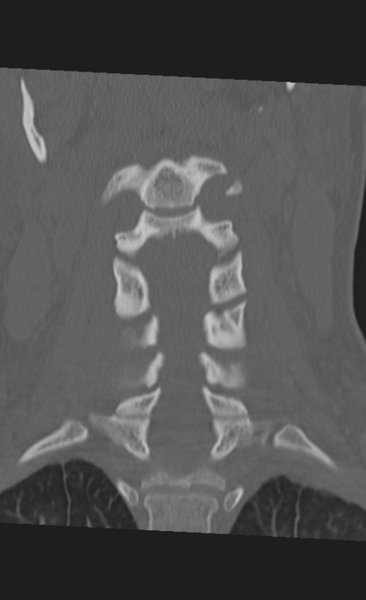 File:Atlanto-occipital dissociation (Radiopaedia 33848-35013 Coronal bone window 21).png