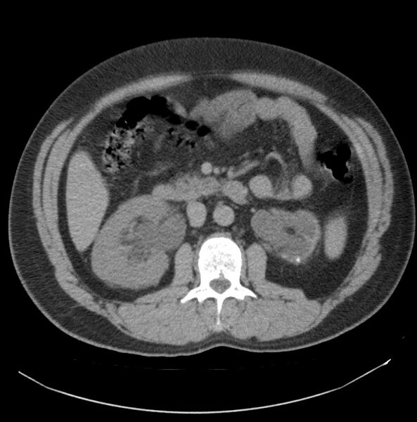 File:Atrophic kidney due to severe chronic obstructive hydronephrosis (Radiopaedia 40828-43474 Axial non-contrast 7).jpg