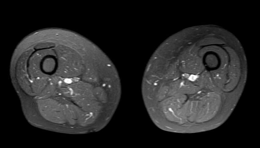 Atypical lipomatous tumor - thigh (Radiopaedia 68975-78734 Axial PD fat sat 42).jpg