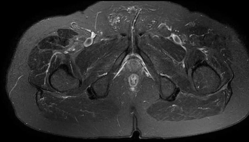 Atypical lipomatous tumor - thigh (Radiopaedia 68975-78734 Axial T2 fat sat 84).jpg