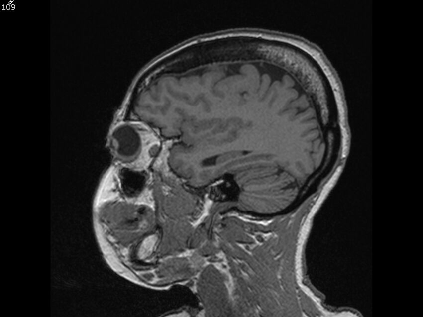 Atypical meningioma - intraosseous (Radiopaedia 64915-74572 Sagittal T1 109).jpg