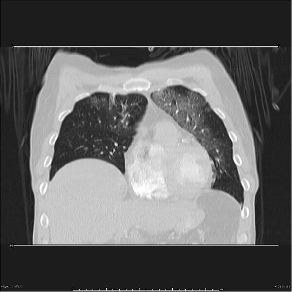 File:Atypical pneumonia - Q fever (Radiopaedia 21993-21989 C 10).jpg