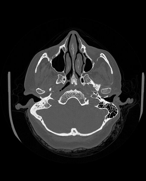 File:Automastoidectomy with labyrinthine fistula (Radiopaedia 84143-99411 Axial non-contrast 72).jpg