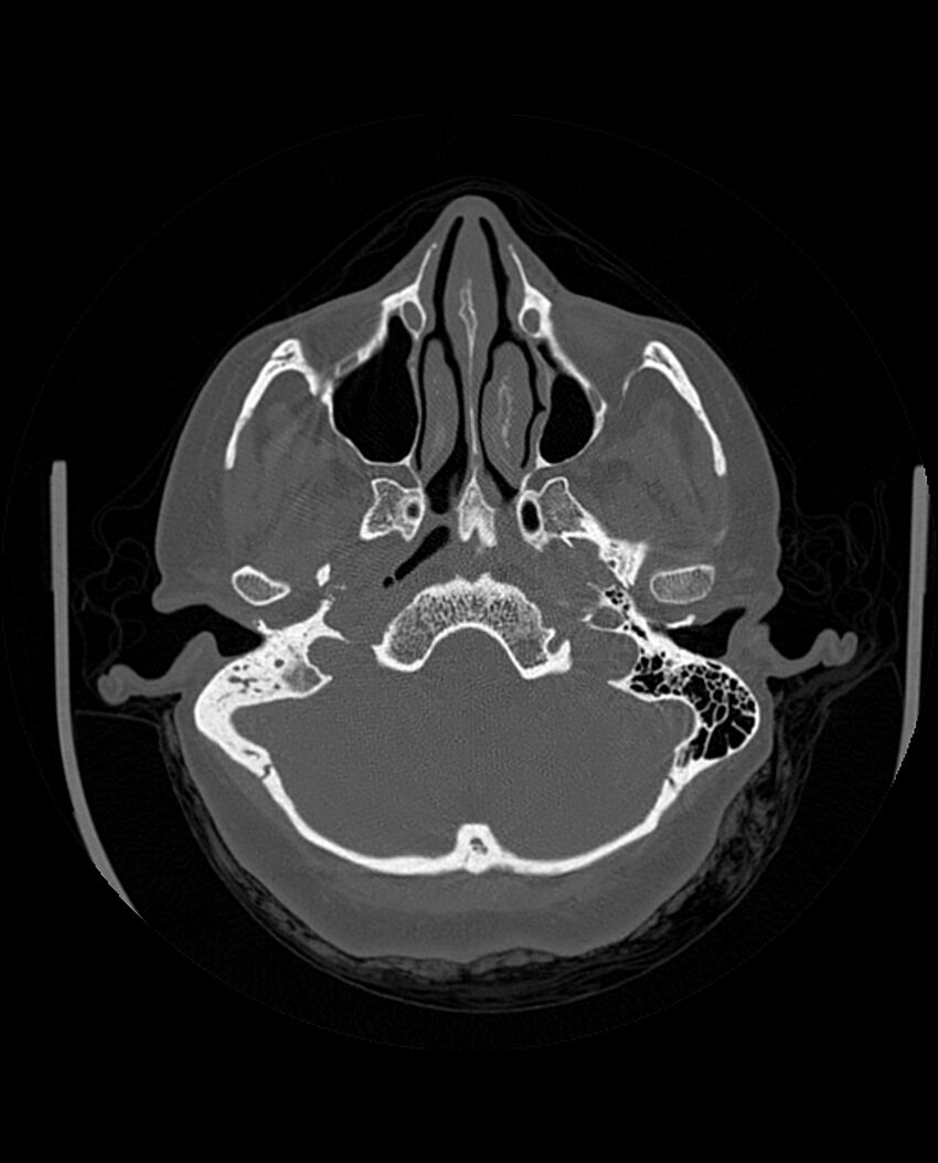 Automastoidectomy with labyrinthine fistula (Radiopaedia 84143-99411 Axial non-contrast 72).jpg