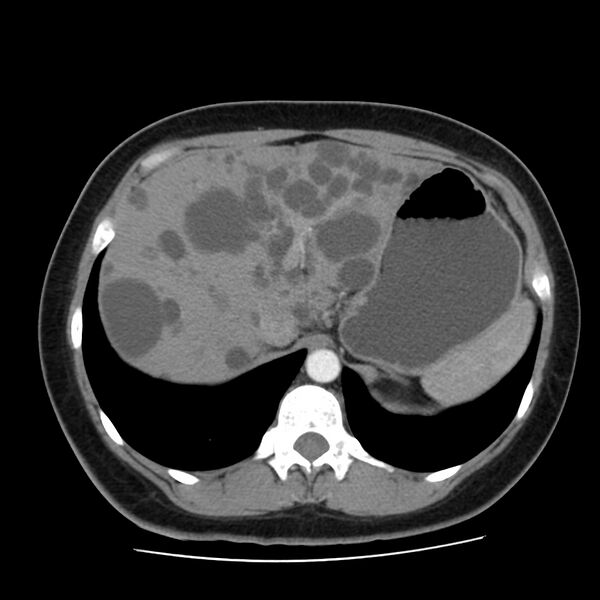 File:Autosomal dominant polycystic kidney disease (Radiopaedia 23061-23093 B 15).jpg