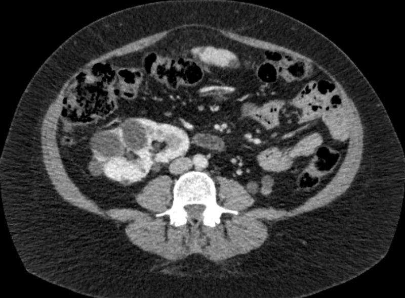 File:Autosomal dominant polycystic kidney disease (Radiopaedia 57124-64017 A 66).jpg