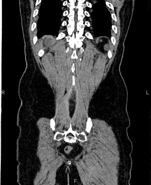 File:Autosomal dominant polycystic kidney disease (Radiopaedia 87830-104287 Coronal non-contrast 60).jpg