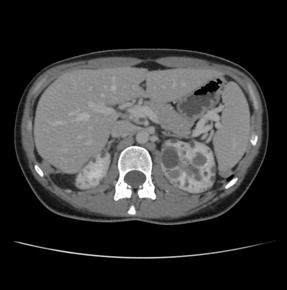 File:Autosomal dominant polycystic kidney disease - early onset (Radiopaedia 40734-43387 A 17).jpg