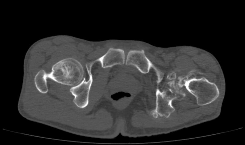 File:Avascular necrosis of the left hip (Radiopaedia 75068-86125 Axial bone window 73).jpg