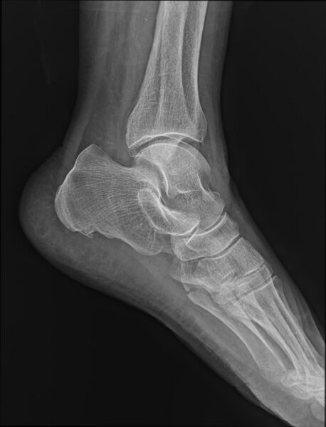 File:Avulsion fracture of the 5th metatarsal styloid (Radiopaedia 67913-77348 Lateral 1).jpg