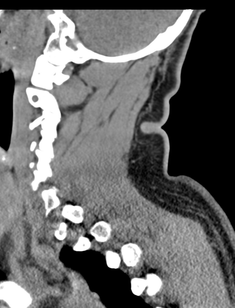 File:Axis peg fracture (type 3) and atlas lateral mass (type 4) fracture (Radiopaedia 37474-39324 D 23).png