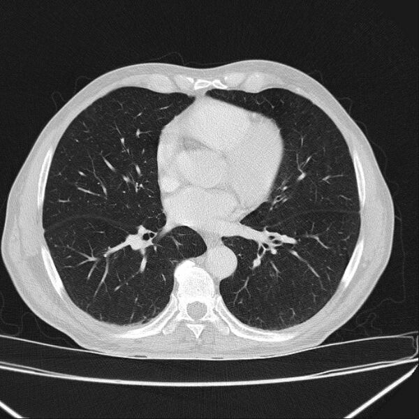 File:Azygos lobe (Radiopaedia 38259-40275 Axial lung window 48).jpg