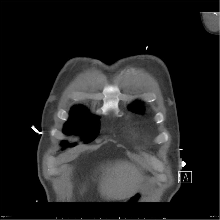 Azygos venous system anatomy (CT pulmonary angiography) (Radiopaedia 25928-26077 Coronal C+ CTPA 7).jpg