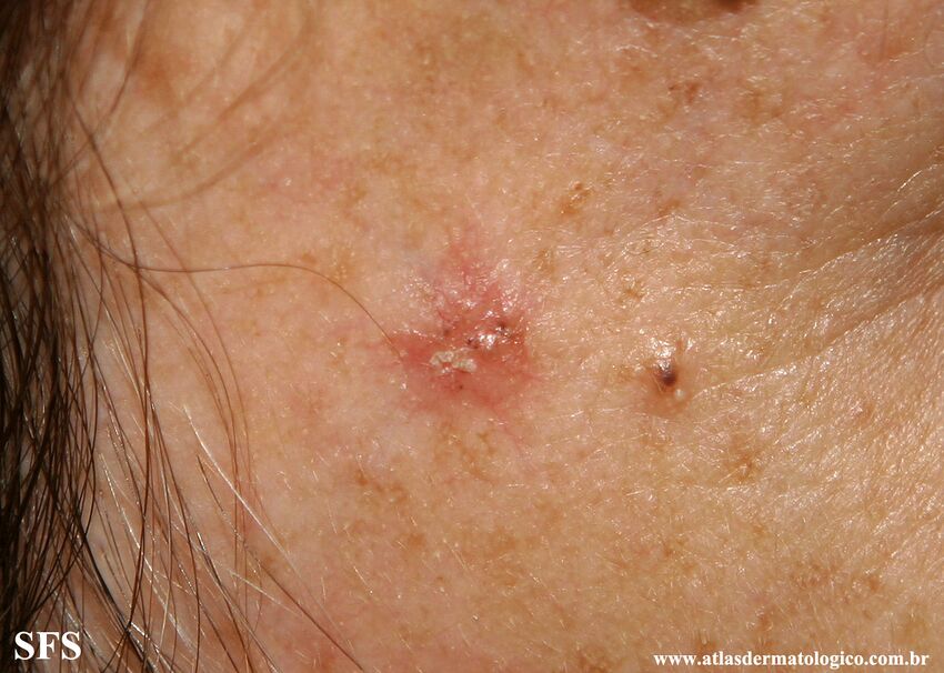 Basal Cell Carcinoma (Dermatology Atlas 337).jpg